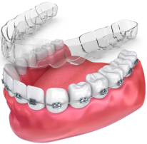 Clear Smile Aligner